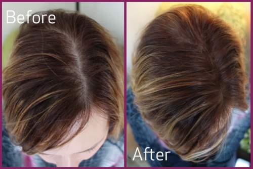 regrow hair top of head